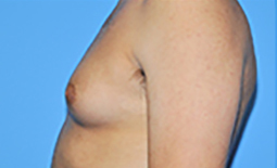 Gynecomastia Before and After Pictures Plano, TX