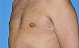 Gynecomastia Before and After Pictures Plano, TX