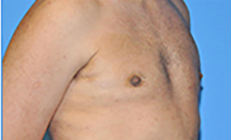 Gynecomastia Before and After Pictures Plano, TX