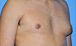 Gynecomastia Before and After Pictures Plano, TX