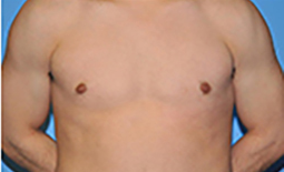 Gynecomastia Before and After Pictures Plano, TX