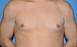 Gynecomastia Before and After Pictures Plano, TX