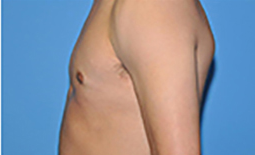 Gynecomastia Before and After Pictures Plano, TX