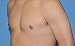 Gynecomastia Before and After Pictures Plano, TX