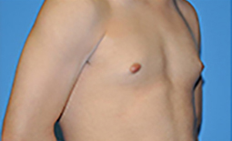 Gynecomastia Before and After Pictures Plano, TX