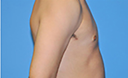 Gynecomastia Before and After Pictures Plano, TX