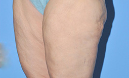 Liposuction Before and After Pictures Plano, TX