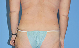Liposuction Before and After Pictures Plano, TX