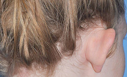 Ear Surgery Before and After Pictures Plano, TX