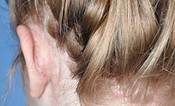 Ear Surgery Before and After Pictures Plano, TX