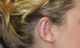 Ear Surgery Before and After Pictures Plano, TX