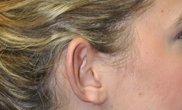 Ear Surgery Before and After Pictures Plano, TX