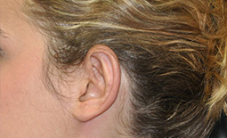 Ear Surgery Before and After Pictures Plano, TX