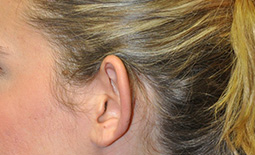 Ear Surgery Before and After Pictures Plano, TX