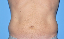 Liposuction Before and After Pictures Plano, TX