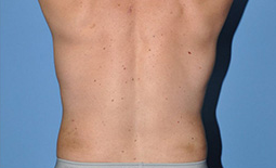 Liposuction Before and After Pictures Plano, TX