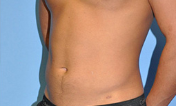 Liposuction Before and After Pictures Plano, TX