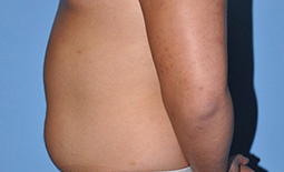 Liposuction Before and After Pictures Plano, TX