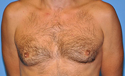 Gynecomastia Before and After Pictures Plano, TX