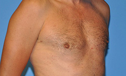 Gynecomastia Before and After Pictures Plano, TX