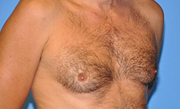 Gynecomastia Before and After Pictures Plano, TX