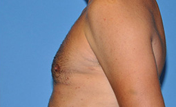 Gynecomastia Before and After Pictures Plano, TX