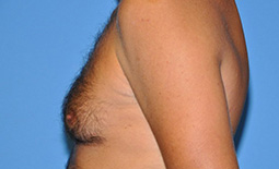 Gynecomastia Before and After Pictures Plano, TX