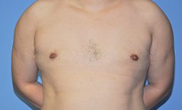 Gynecomastia Before and After Pictures Plano, TX