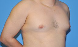 Gynecomastia Before and After Pictures Plano, TX