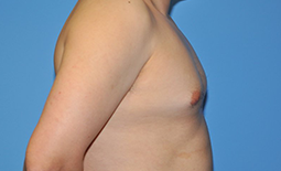 Gynecomastia Before and After Pictures Plano, TX