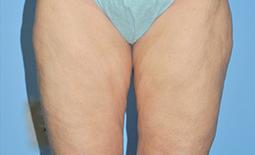 Liposuction Before and After Pictures Plano, TX