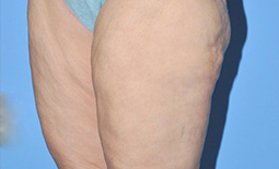 Liposuction Before and After Pictures Plano, TX