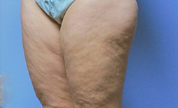 Liposuction Before and After Pictures Plano, TX