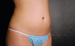 Liposuction Before and After Pictures Plano, TX