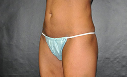 Liposuction Before and After Pictures Plano, TX