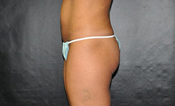 Liposuction Before and After Pictures Plano, TX