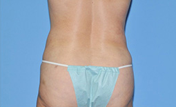 Liposuction Before and After Pictures Plano, TX