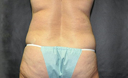 Liposuction Before and After Pictures Plano, TX