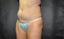 Liposuction Before and After Pictures Plano, TX