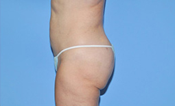 Liposuction Before and After Pictures Plano, TX