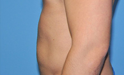 Liposuction Before and After Pictures Plano, TX