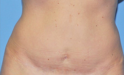 Liposuction Before and After Pictures Plano, TX