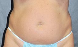 Liposuction Before and After Pictures Plano, TX