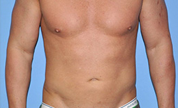 Liposuction Before and After Pictures Plano, TX