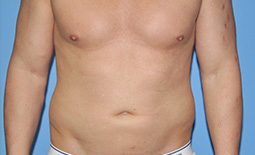 Liposuction Before and After Pictures Plano, TX