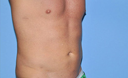 Liposuction Before and After Pictures Plano, TX