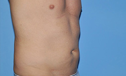 Liposuction Before and After Pictures Plano, TX