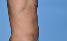 Liposuction Before and After Pictures Plano, TX