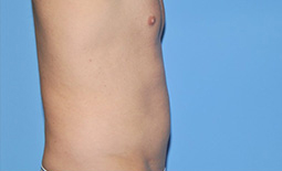 Liposuction Before and After Pictures Plano, TX