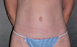 Tummy Tuck Before and After Pictures Plano, TX